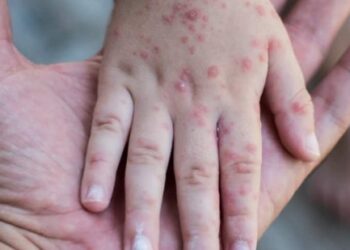 Kasus Cacar Monyet Muncul di Kota Bandung